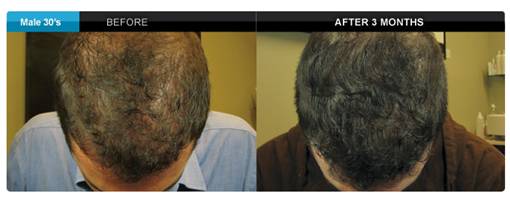 Fremont Hair Regrowth Fremont