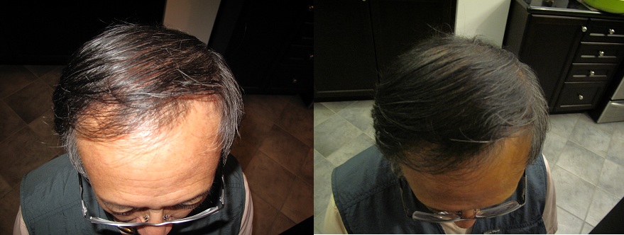 Laser Hair Regrowth Fremont