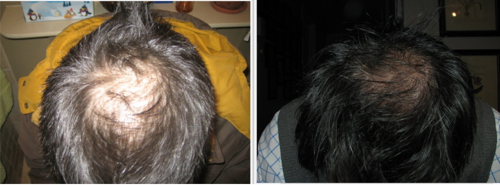 Laser Hair Regrowth