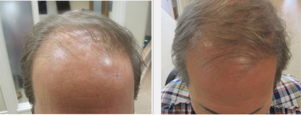 Hair Loss Treatments Fremont