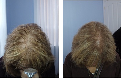 Fremont Hair Regrowth