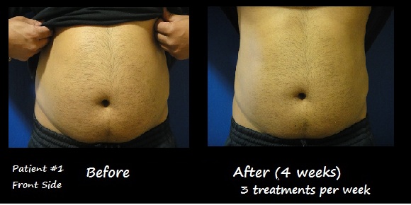 Fat Reduction Fremont